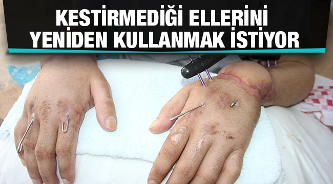  Kestirmediği ellerini yeniden kullanmak istiyor