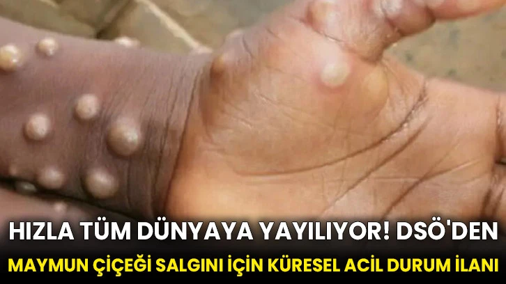 Hızla tüm dünyaya yayılıyor! DSÖ'den maymun çiçeği salgını için küresel acil durum ilanı